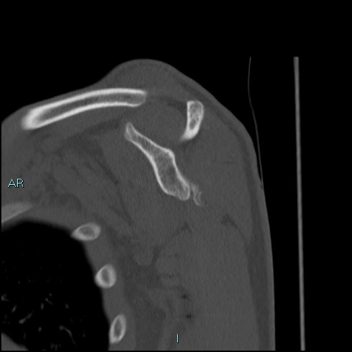 File:Avascular necrosis after fracture dislocations of the proximal humerus (Radiopaedia 88078-104653 Sagittal bone window 42).jpg