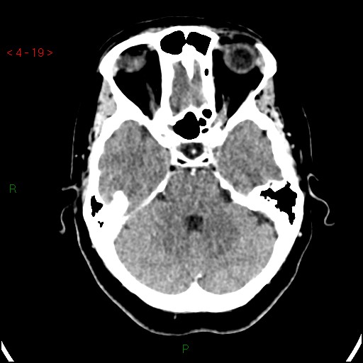 Azygos anterior cerebral artery (Radiopaedia 51987-57833 A 19).jpg