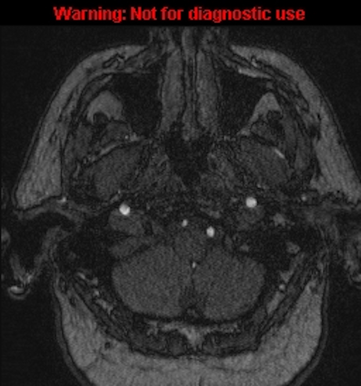 Azygos anterior cerebral artery (Radiopaedia 59325-66677 Axial MRA 9).jpg