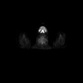 B-cell lymphoma of the mesentery (Radiopaedia 65743-74868 18F-FDG PET-CT 249).jpg