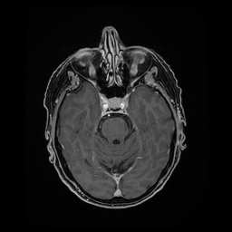 Balo concentric sclerosis (Radiopaedia 53875-59982 Axial LAVA C+ 90).jpg