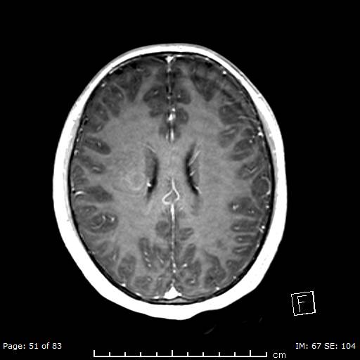 Balo concentric sclerosis (Radiopaedia 61637-69636 Axial T1 C+ 51).jpg
