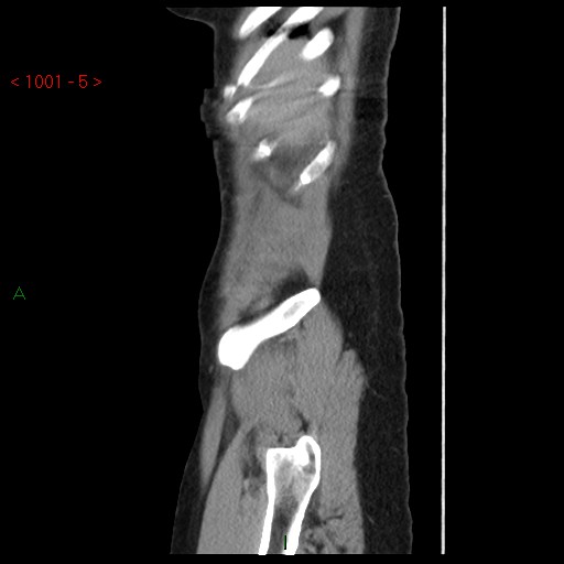 File:Bartholin gland cyst (Radiopaedia 54904-61181 Sagittal C+ delayed 5).jpg