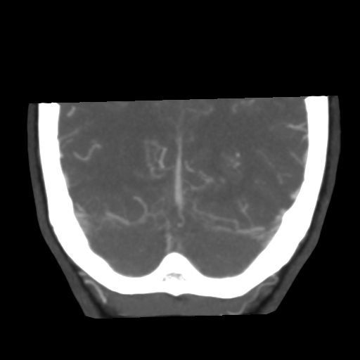 Basilar artery fenestration and aneurysms with subarachnoid hemorrhage (Radiopaedia 40066-42573 B 46).png