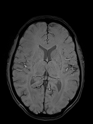 Basilar artery perforator aneurysm (Radiopaedia 82455-97733 Axial SWI 31).jpg