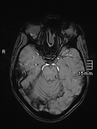 File:Basilar artery perforator aneurysm (Radiopaedia 82455-99523 Axial SWI 23).jpg