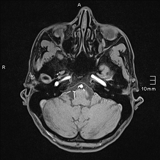 Basilar artery perforator aneurysm (Radiopaedia 82455-99523 F 21).jpg