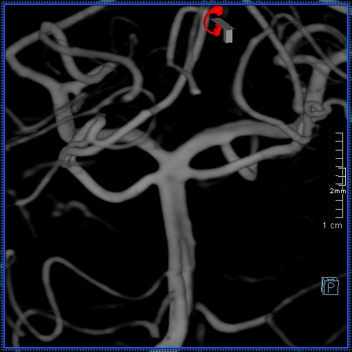 Basilar artery perforator aneurysm (Radiopaedia 82455-99524 3D Left VA 1).jpg