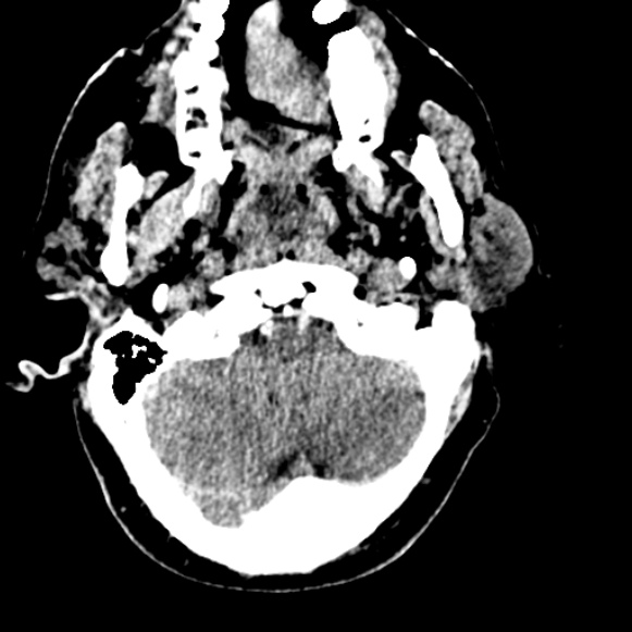 Basilar artery thrombosis (Radiopaedia 53351-59333 Axial non-contrast 26).jpg