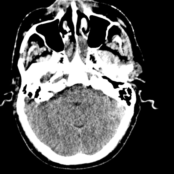 Basilar artery thrombosis (Radiopaedia 53351-59333 Axial non-contrast 41).jpg