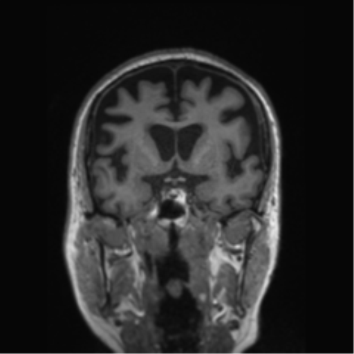 Behavioral variant frontotemporal dementia and late onset schizophrenia (Radiopaedia 52197-58083 Coronal T1 57).png