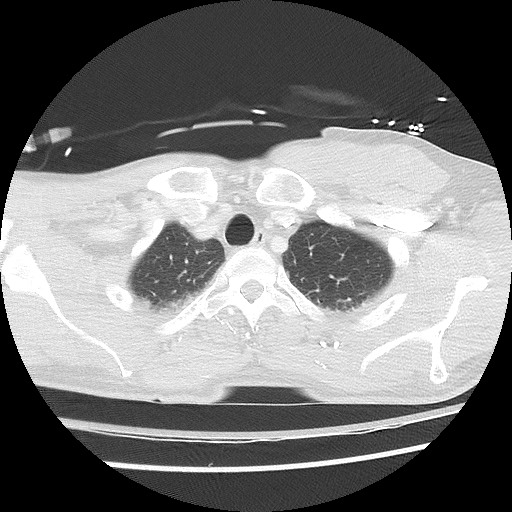Benign post-traumatic pseudopneumoperitoneum (Radiopaedia 71199-81495 Axial lung window 18).jpg