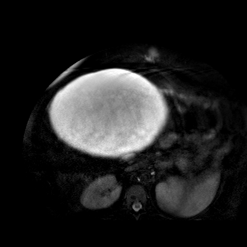 File:Benign seromucinous cystadenoma of the ovary (Radiopaedia 71065-81300 T2 SPAIR 32).jpg