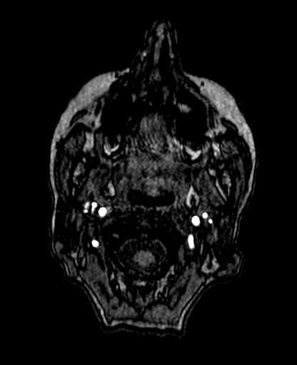 Berry aneurysm of the terminal internal carotid artery (Radiopaedia 88286-104918 Axial TOF 10).jpg