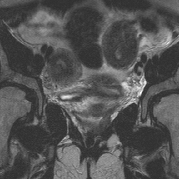 File:Bicornuate uterus (Radiopaedia 24677-24949 Coronal T2 3).jpg