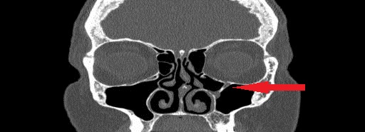 File:Bilateral Ectopic Infraorbital Nerves (Radiopaedia 49006-58325 Coronal 7).jpg