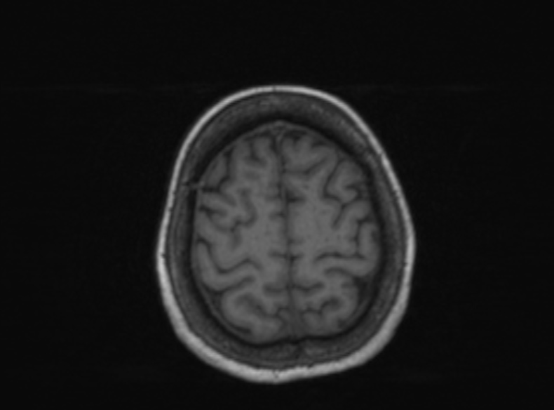 Bilateral PCA territory infarction - different ages (Radiopaedia 46200-51784 Axial T1 149).jpg