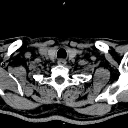 Bilateral Warthin tumors (Radiopaedia 84034-99263 Axial non-contrast 55).jpg