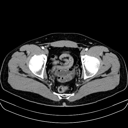 File:Bilateral accessory renal arteries with mild pelvi-ureteric junction (PUJ) obstruction (Radiopaedia 66357-75596 A 68).jpg