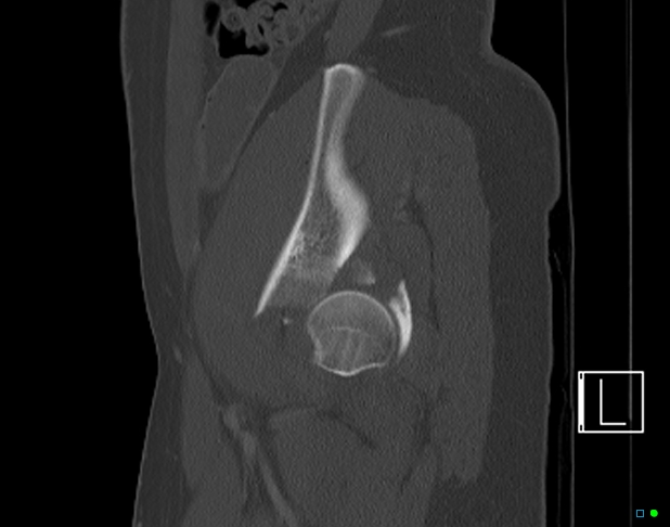 Bilateral acetabular fractures (Radiopaedia 79272-92308 Sagittal bone window 69).jpg