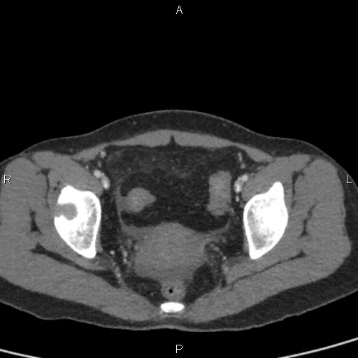 Bilateral adrenal gland hyperenhancement in pancreatitis (Radiopaedia 86642-102753 E 100).jpg