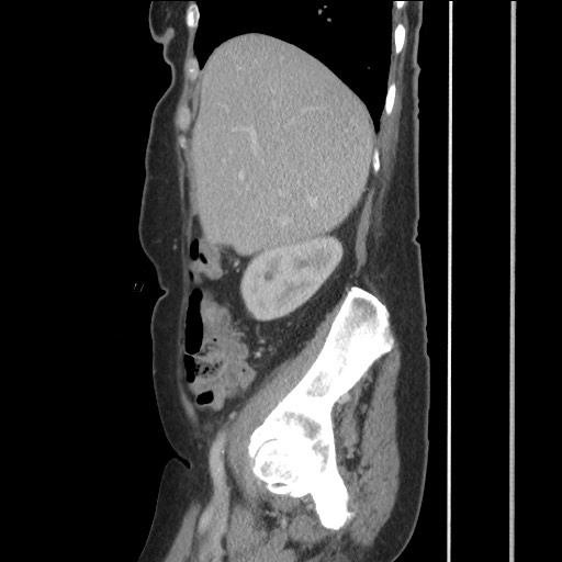 Bilateral adrenal granulocytic sarcomas (chloromas) (Radiopaedia 78375-91007 C 45).jpg