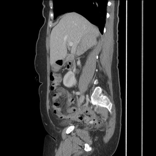 Bilateral adrenal granulocytic sarcomas (chloromas) (Radiopaedia 78375-91007 C 57).jpg