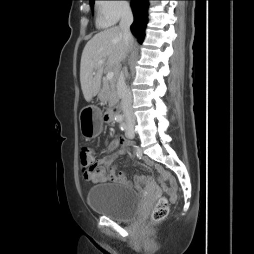 Bilateral adrenal granulocytic sarcomas (chloromas) (Radiopaedia 78375-91007 C 68).jpg