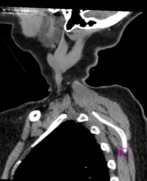 Bilateral atlanto-occipital assimilation (Radiopaedia 28350-28603 D 4).jpg