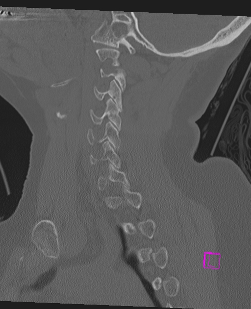 Bilateral atlanto-occipital assimilation (Radiopaedia 28350-28603 Sagittal bone window 27).jpg