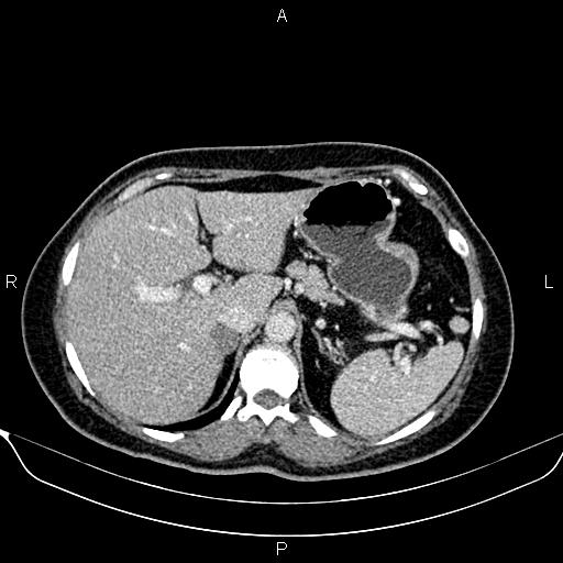 Bilateral benign adrenal adenomas (Radiopaedia 86912-103124 B 28).jpg