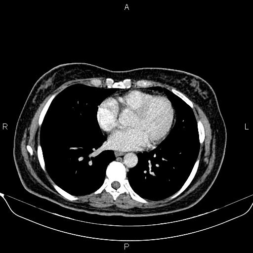 Bilateral benign adrenal adenomas (Radiopaedia 86912-103124 B 5).jpg