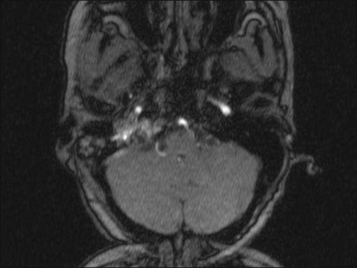 Bilateral carotid body tumors and right glomus jugulare tumor (Radiopaedia 20024-20060 Axial MRA 311).jpg