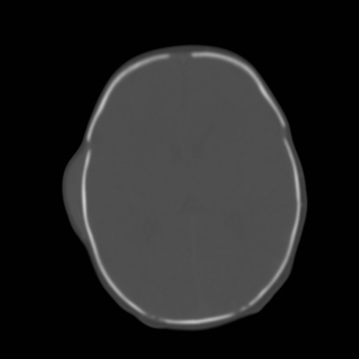 File:Bilateral cephalohematomas and subdural hematomas (Radiopaedia 26778-26929 Axial bone window 16).jpg