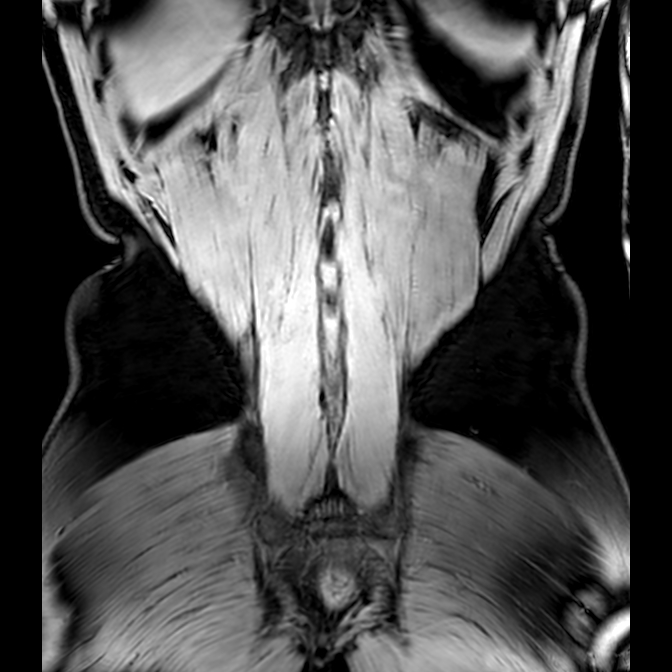 Bilateral conjoined nerve roots at different levels (Radiopaedia 73312-84063 Coronal WE 53).jpg