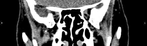 File:Bilateral enlargement of lacrimal glands - sarcoidosis (Radiopaedia 62627-70921 Coronal non-contrast 20).jpg