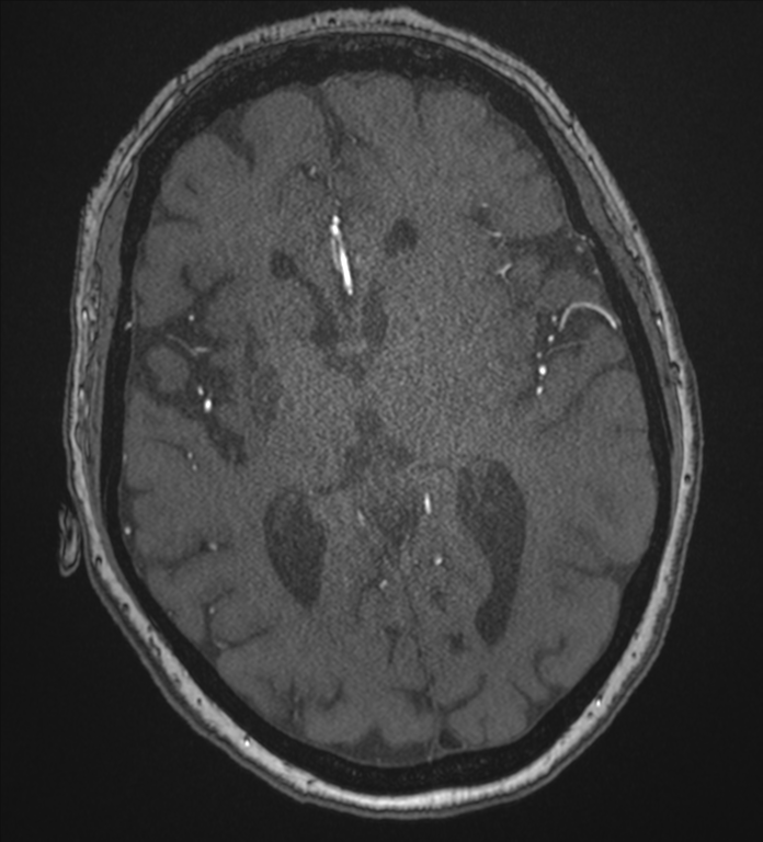 Bilateral fetal posterior communicating arteries (Radiopaedia 41286-44102 Axial MRA 115).png