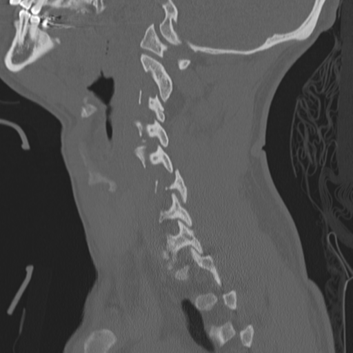 Bilateral locked facets (Radiopaedia 33850-35016 Sagittal bone window 12).png