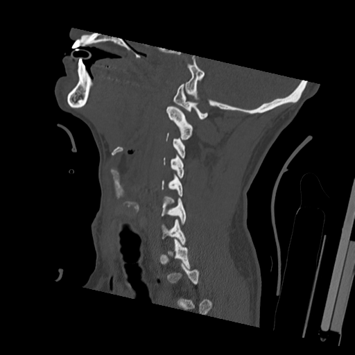 Bilateral locked facets (Radiopaedia 33850-35023 Sagittal bone window 41).png