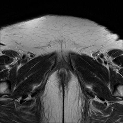 File:Bilateral ovarian dermoid cysts (Radiopaedia 90152-107338 Axial T2 24).jpg