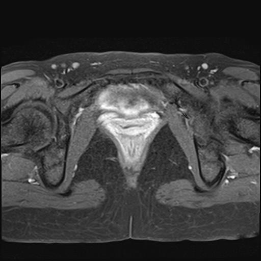File:Bilateral ovarian endometriomas (Radiopaedia 87085-103347 Axial T1 C+ fat sat 19).jpg