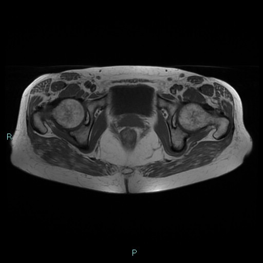 File:Bilateral ovarian fibroma (Radiopaedia 44568-48293 Axial T1 23).jpg