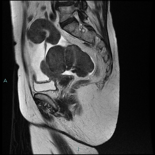 File:Bilateral ovarian fibroma (Radiopaedia 44568-48293 Sagittal T2 21).jpg