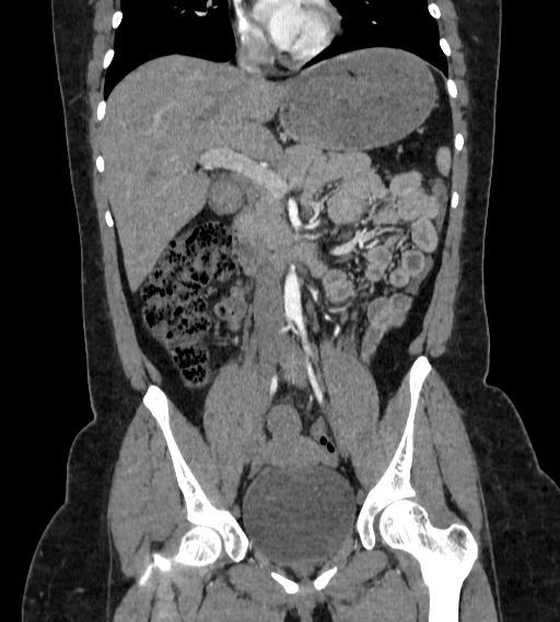 File:Bilateral ovarian mature cystic teratomas (Radiopaedia 79373-92457 B 28).jpg