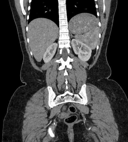 Bilateral ovarian mature cystic teratomas (Radiopaedia 79373-92457 B 76).jpg
