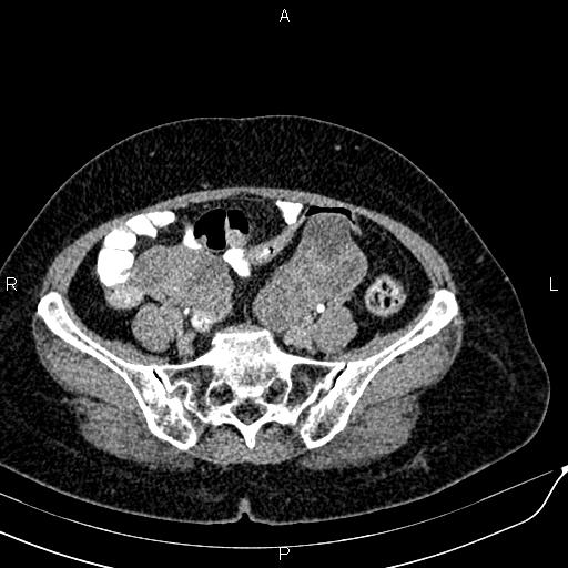 Bilateral ovarian serous cystadenocarcinoma (Radiopaedia 86062-101989 Axial C+ delayed 57).jpg
