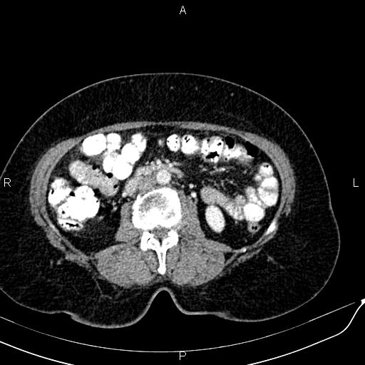 Bilateral ovarian serous cystadenocarcinoma (Radiopaedia 86062-101989 B 50).jpg