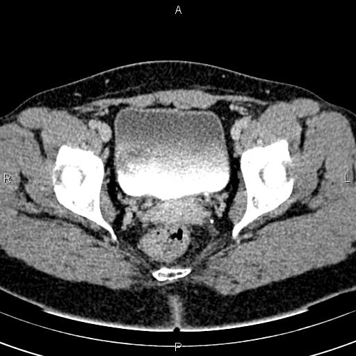 Bilateral ovarian teratoma (Radiopaedia 83131-97503 B 61).jpg