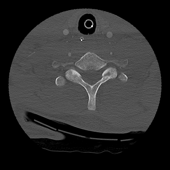 Bilateral perched facets with cord injury (Radiopaedia 45587-49713 Axial bone window 86).jpg