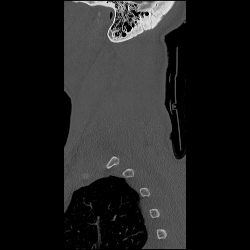 Bilateral perched facets with cord injury (Radiopaedia 45587-49713 Sagittal bone window 54).jpg